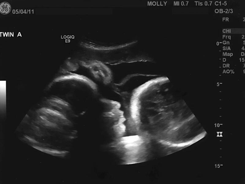 66-летняя женщина пришла к гинекологу и утверждала, что она на девятом месяце беременности — но когда врач осмотрел её, он пришёл в ужас от увиденного