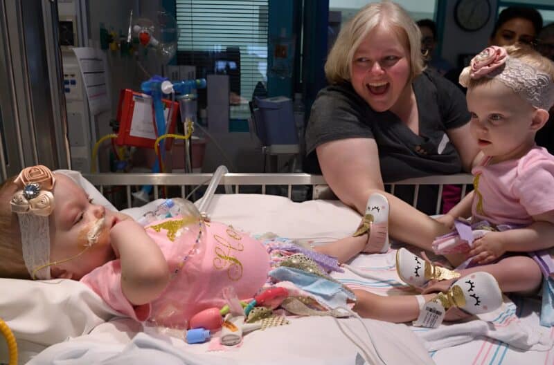 Сестры близнецы родились соединенными в области груди и живота: вы будете в шоке, когда увидите их после разделения