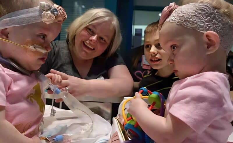 Сестры близнецы родились соединенными в области груди и живота: вы будете в шоке, когда увидите их после разделения