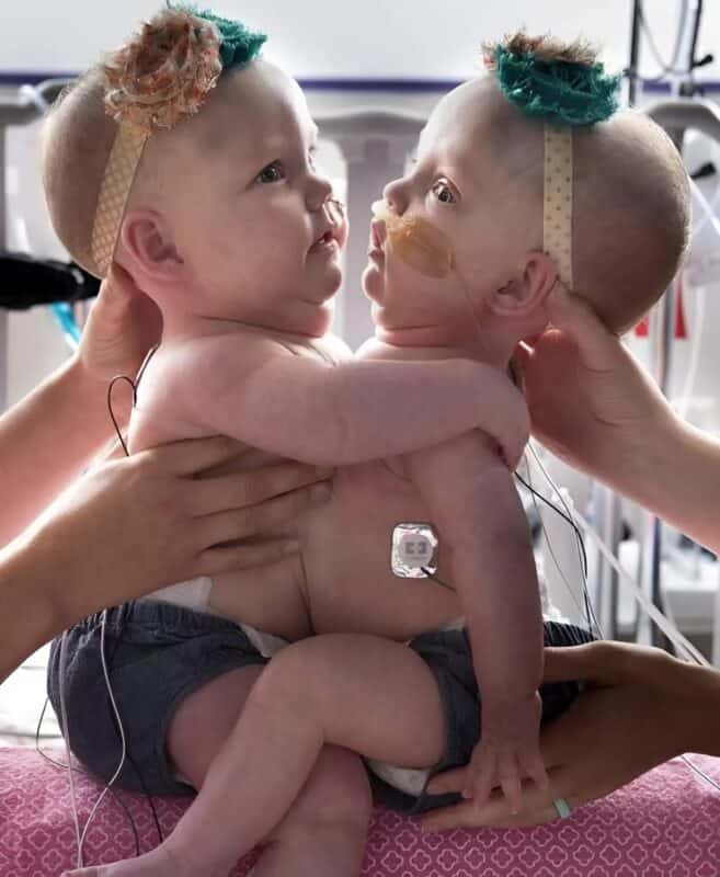 Сестры близнецы родились соединенными в области груди и живота: вы будете в шоке, когда увидите их после разделения
