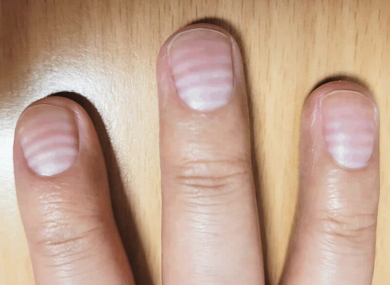 Если вы заметили такие же странные линии на своих ногтях, немедленно обратитесь к врачу, ведь это значит, что у вас...