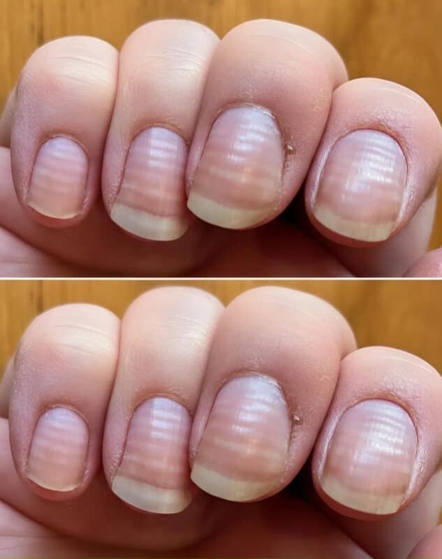 Если вы заметили такие же странные линии на своих ногтях, немедленно обратитесь к врачу, ведь это значит, что у вас...